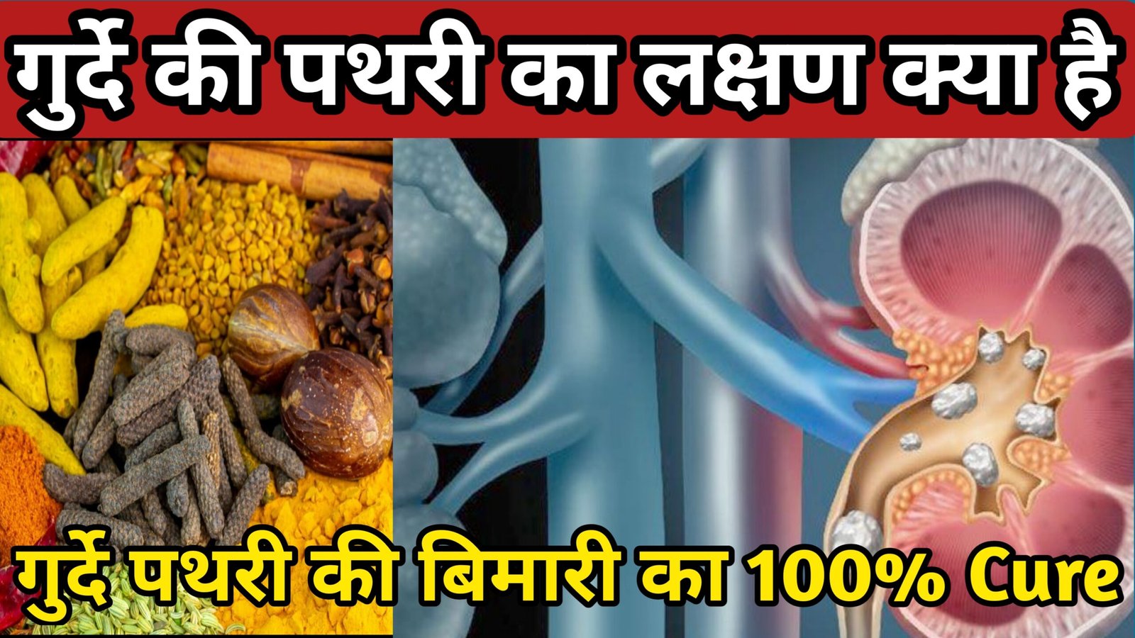 गुर्दे की पथरी का आयुर्वेदिक इलाज क्या है